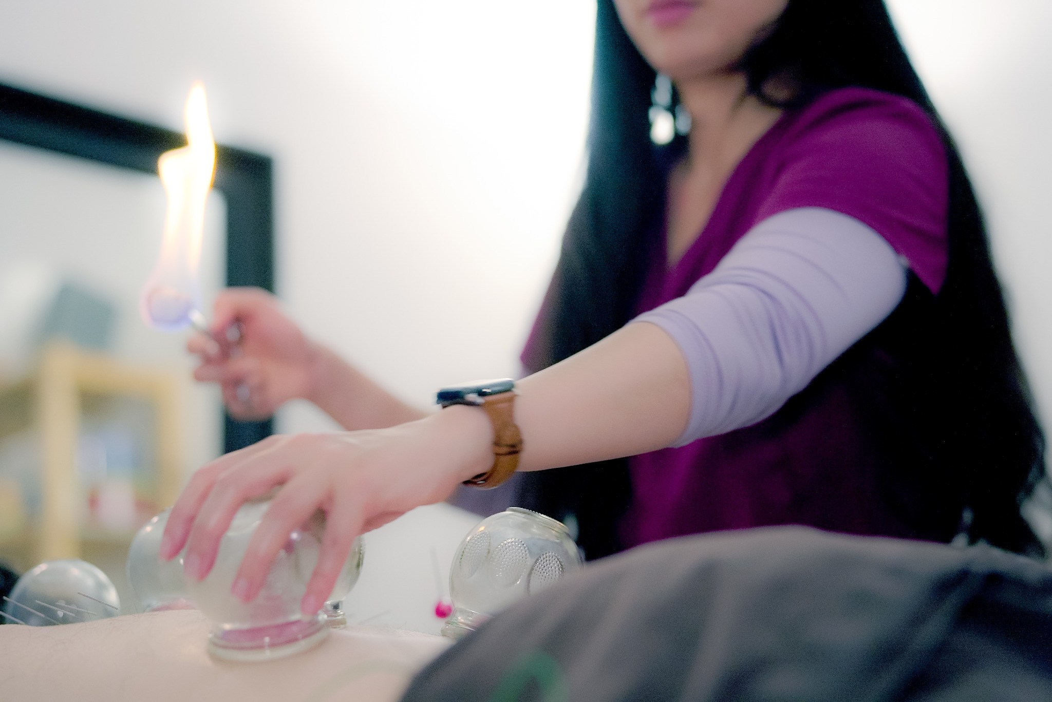 Fire Cupping